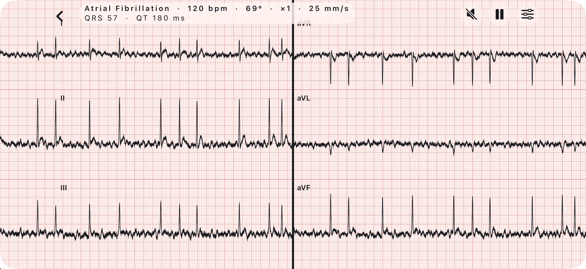 ECG Training on an iPhone: atrial fibrillation at 120 bpm on six leads, on ECG paper.